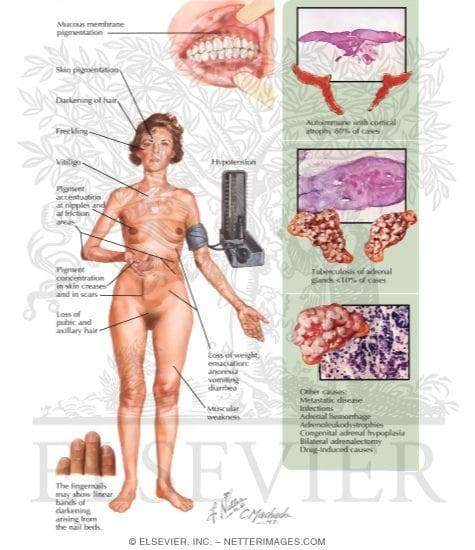 Addison Hastalığı (Adrenal Yetmezlik)
