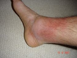 Ailesel Akdeniz Ateşi (FMF)