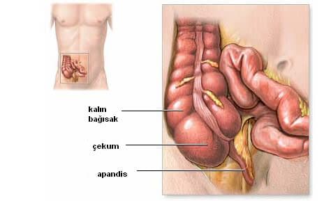 Apandisit (Akut apandisit)