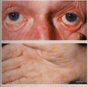 Aplastik Anemi Nedir