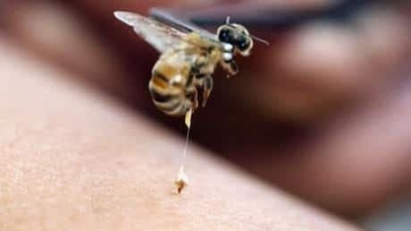 Arı Sokması Tedavisi