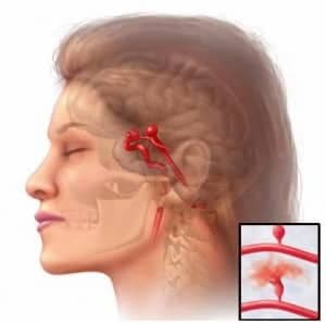 Beyin Kanaması Neden Olur ?