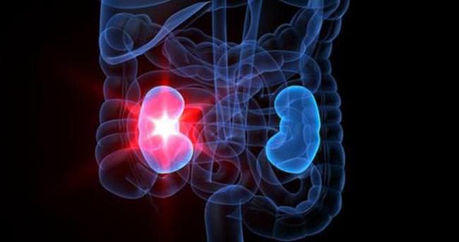 Kronik Böbrek Yetmezliği  Belirtileri