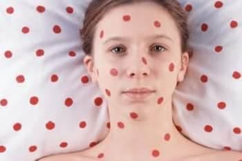 Bulaşıcı Hastalıklar Nelerdir?