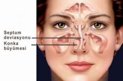 Burun Tıkanıklığı Nasıl Geçer?