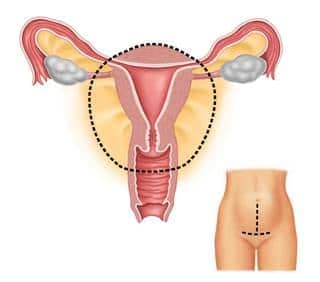 Histerektomi Nedenleri