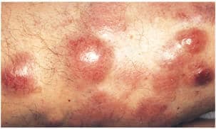 Hodgkin Dışı Lenfoma (Erişkinde)