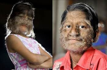 Süper Erkek Hastalığı Belirtileri