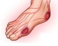 Diyabetik Ayak Tedavisi