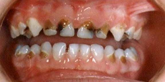 Diş Çürüğü Başlangıcı