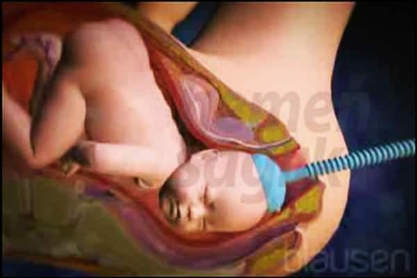 Vakumla Doğum Nedir?