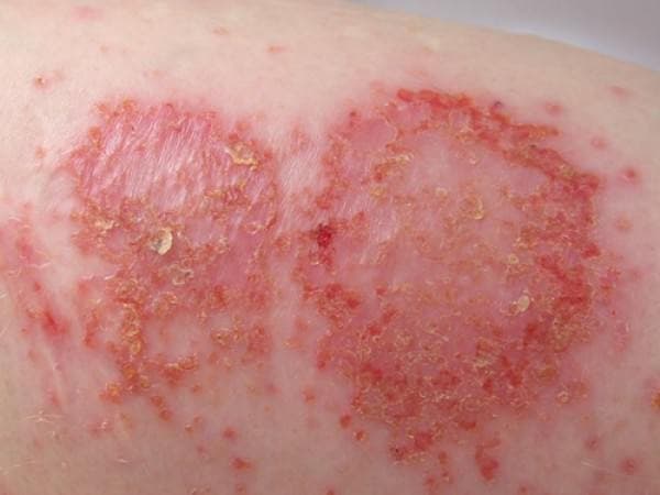 Egzema Hastalığı Tedavisi