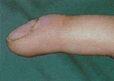 Çekiç Parmak Ameliyatı