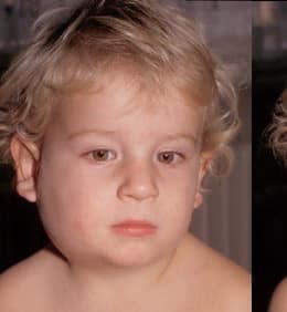 Kabakulak Belirtileri