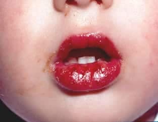 Kawasaki Hastalığı