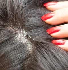 Kepeklenme Neden Olur?