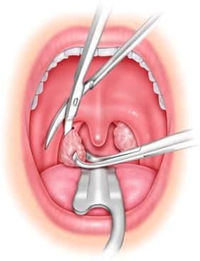Geniz Eti Ameliyatı