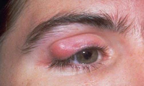 Göz Kapağı Tümörleri