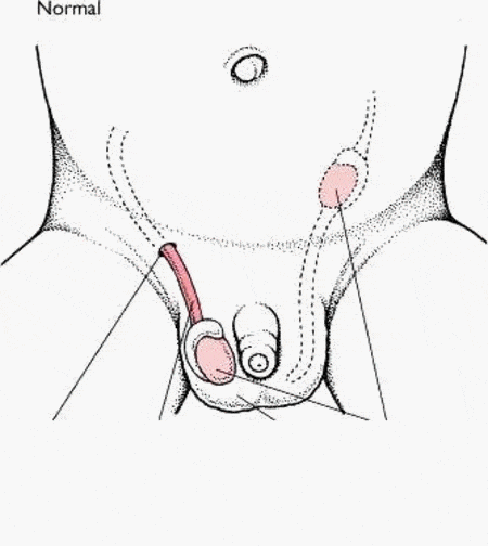 İnmemiş Testis Ameliyatı ve Sünnet