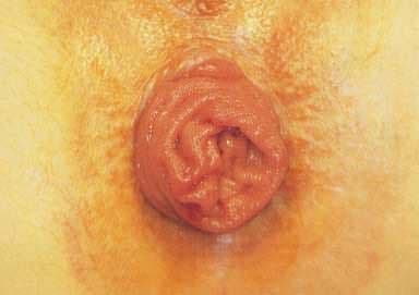 Rektal Prolapsus Nedenleri?