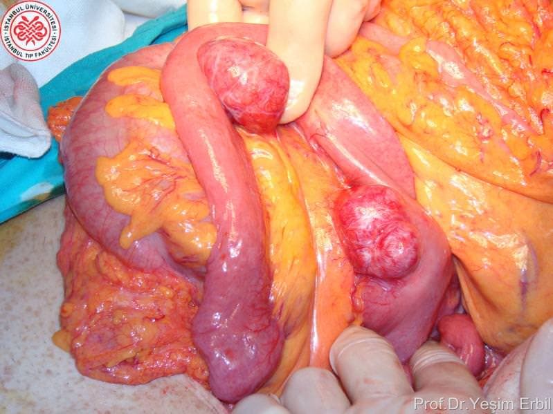 Feokromasitoma Hastalığı Tedavisi