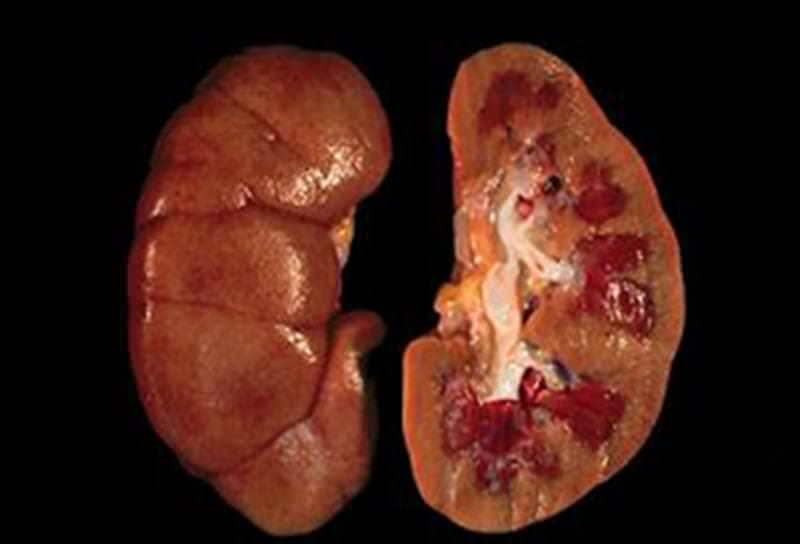 Üremi Nedir Tedavileri Nelerdir?