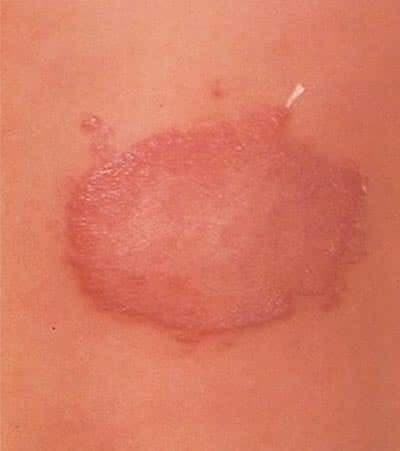 Ürtiker (Kurdeşen)