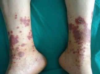 Kriyoglobulinemik Vaskülit