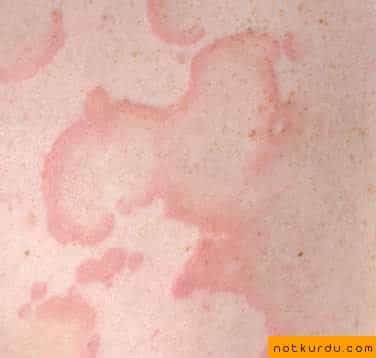 Vaskülit (Ürtikeriyal)