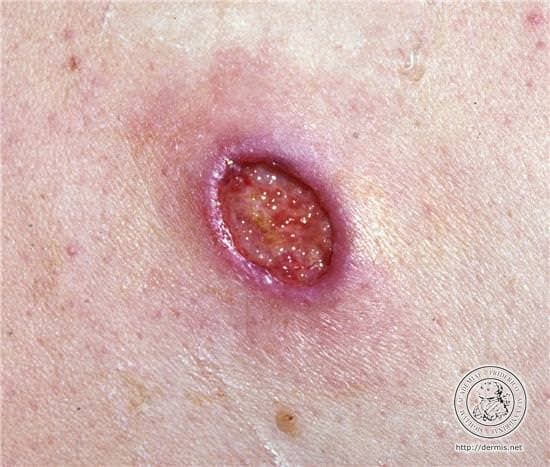 Wegener Granülomatozu Nedir?