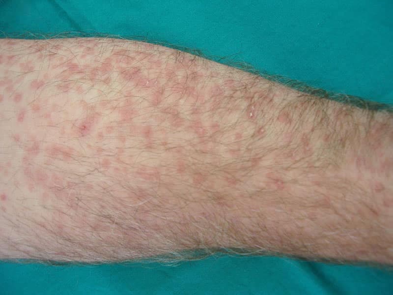 Liken Planus Hastalığı Nedir?