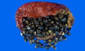 Safra Taşı Bitkisel Tedavi