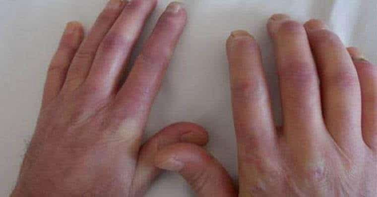 Polimiyozit – Dermatomiyozit