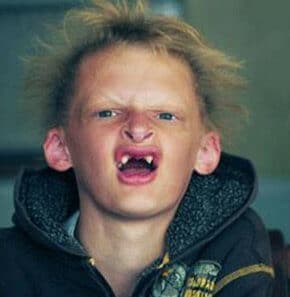 Porfiria Hastalığı