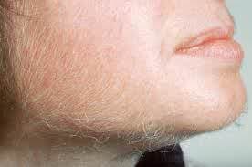 Kıllanma (Tüylenme)