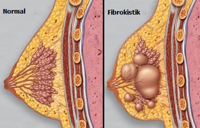 MEMENİN FİBROKİSTİK DEĞİŞİKLİKLERİ