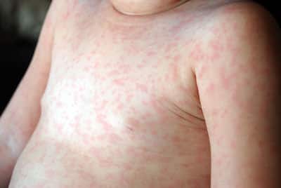ALTINCI HASTALIK (ROSEOLA İNFANTUM)