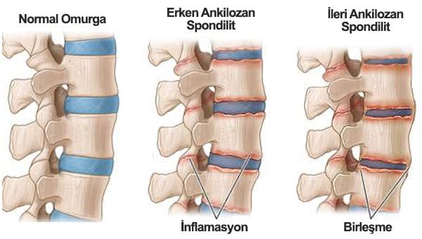 Ankilozan Spondilit