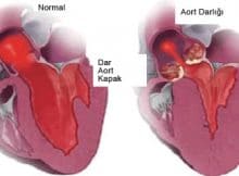 Aort Darlığı