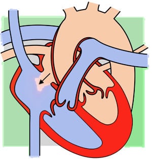 Atriyal Septal Defekt (ASD)