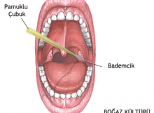 Bademcik İltihabı