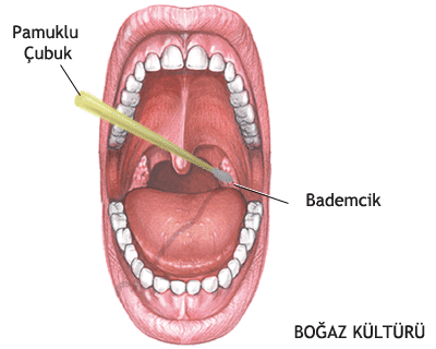 Bademcik İltihabı