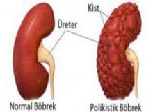 Böbrek Kisti