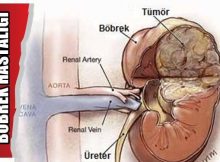 bobrek_ustu_bezi_tumorleri