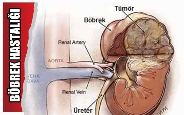 bobrek_ustu_bezi_tumorleri