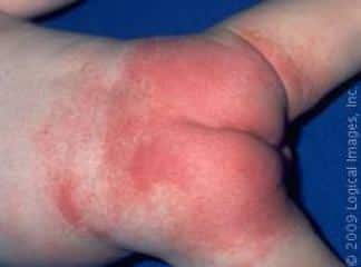 Diaper Dermatit (Pişik)