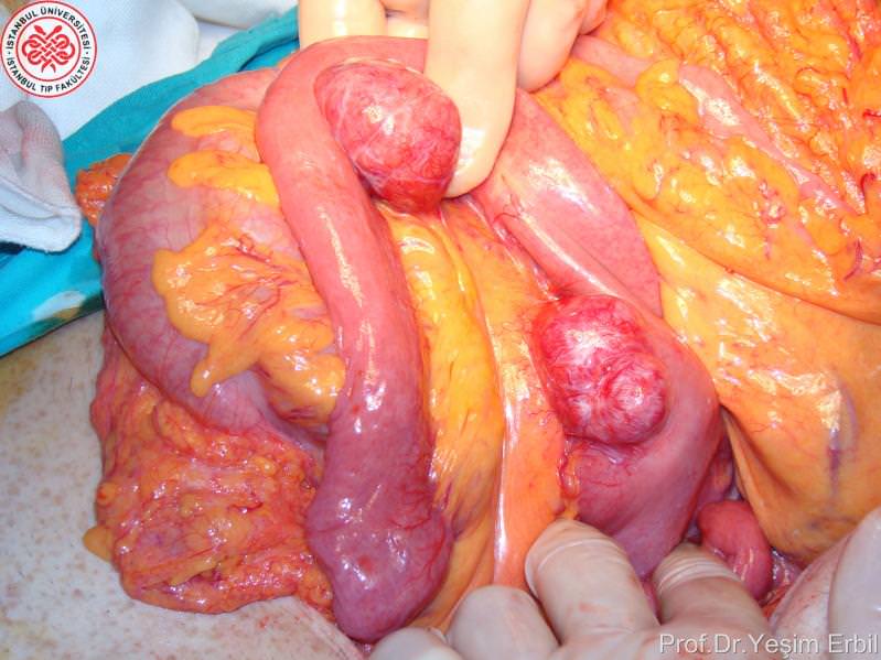 FEOKROMASİTOMA