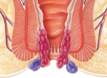 Hemoroid (Basur)