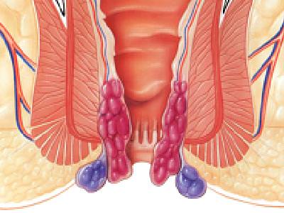 Hemoroid (Basur)