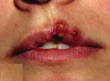 Herpes (Uçuk)